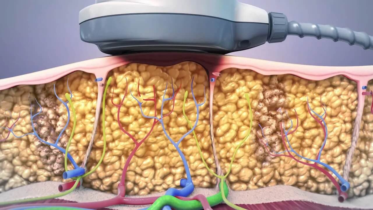 UltraShape Mechanism of Action